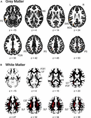 Persistent Differences in Brain Structure in Developmental Dyscalculia: A Longitudinal Morphometry Study